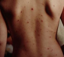 1993, Gloucestershire, England, UK --- Measles Spots on Child's Back --- Image by © John Heseltine/CORBIS
