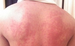 zika_virus
