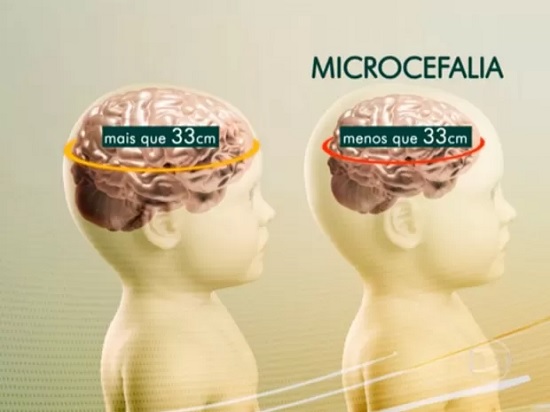 microcefaleia