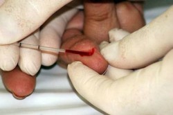 teste aids