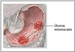 ulcera