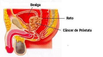cancer prostata