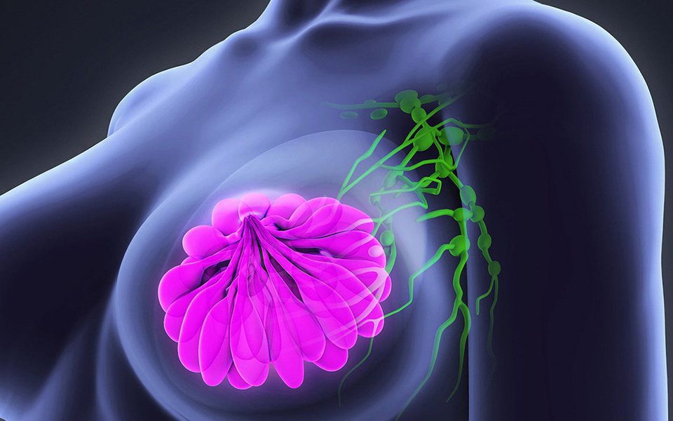 Cientistas desenvolvem ação localizada contra o câncer de mama